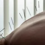 Is Acupuncture the Miracle Remedy for Everything?