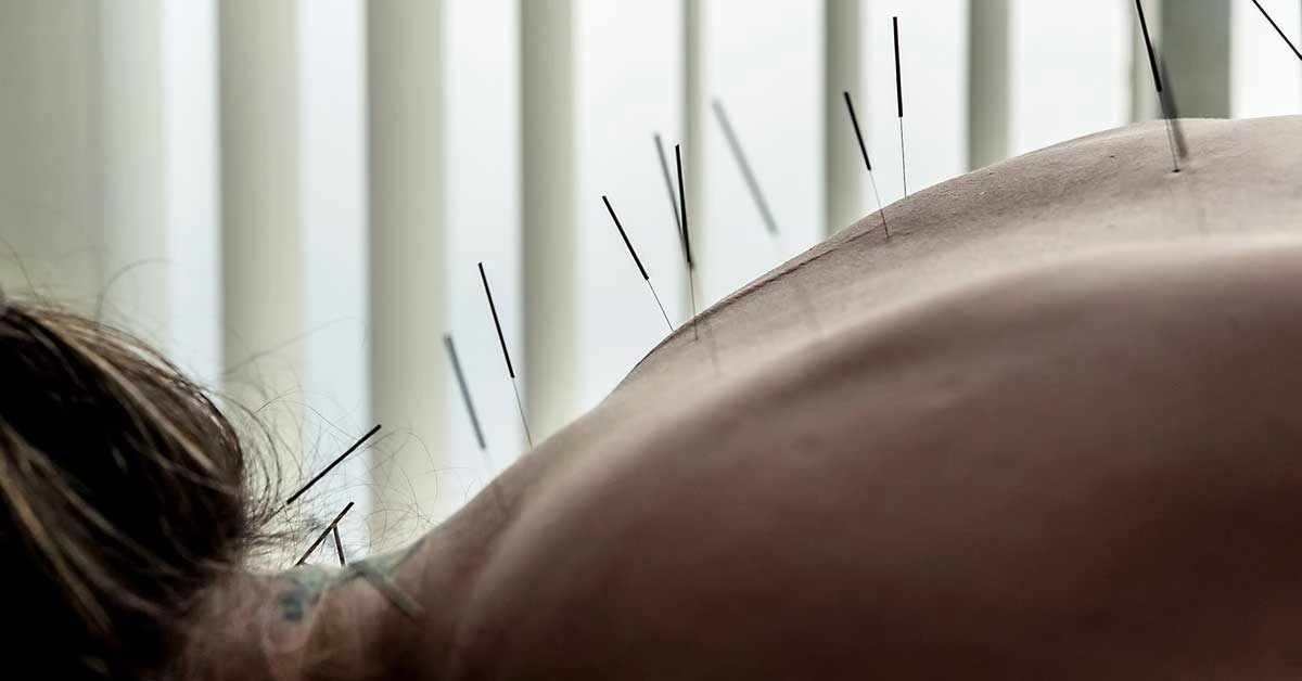 Is Acupuncture the Miracle Remedy for Everything?