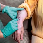 Actinic purpura (Senile Purpura) Actinic purpura (Senile Purpura)