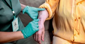 Actinic purpura (Senile Purpura) Actinic purpura (Senile Purpura)