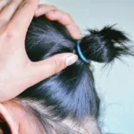 Laser Treatment for Hair Loss
