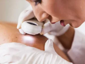 Early Stage Melanoma Pictures: Visual Signs & Symptoms