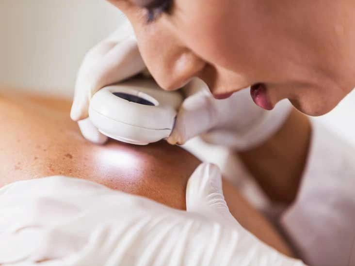 Early Stage Melanoma Pictures: Visual Signs & Symptoms