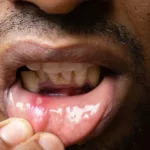 Mouth Sores: Symptoms, Treatment, and Prevention