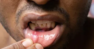 Mouth Sores: Symptoms, Treatment, and Prevention