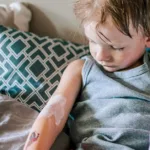 What Bedbug Bites Look Like and How to Get Rid of Them