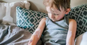 What Bedbug Bites Look Like and How to Get Rid of Them