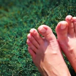 What Exactly Is Morton’s Toe (Longer Second Toe)?
