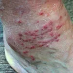 What Does a Chigger Bite Look Like and How to Treat It