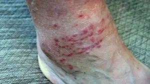 What Does a Chigger Bite Look Like and How to Treat It