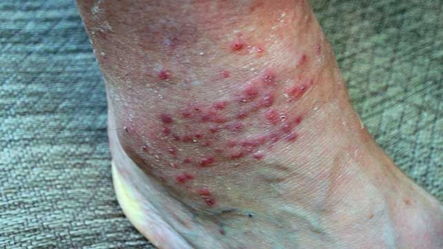 What Does a Chigger Bite Look Like and How to Treat It