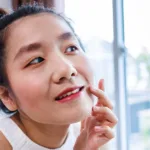 What Is Angular Cheilitis?