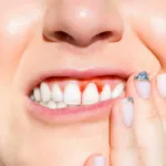 Apixaban, Oral Tablet