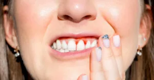 Apixaban, Oral Tablet